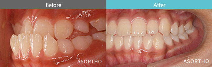 成長期のお子様の受け口改善（ブラケット矯正）