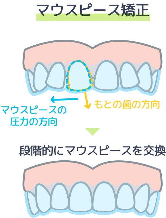 マウスピース矯正