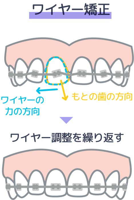 ワイヤー矯正